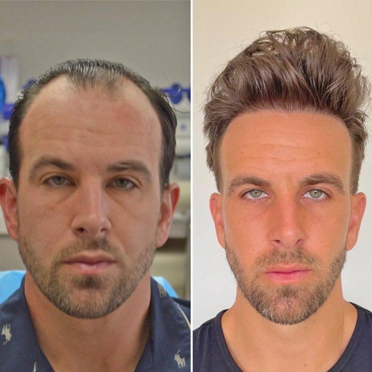 How to remove scabs after Hair Transplant? - PGM B Consultancy